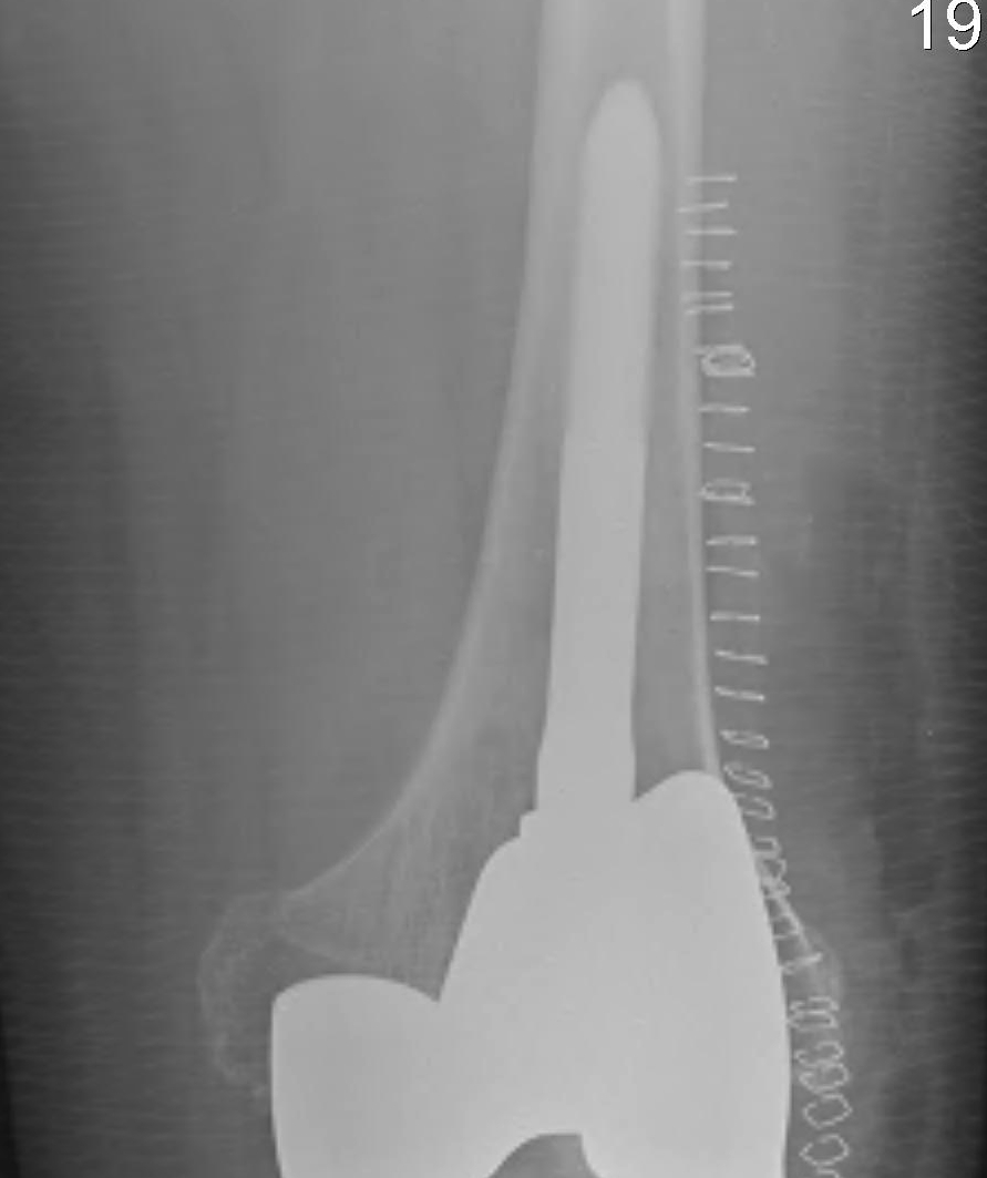 Revision TKR Uncemented Femoral Stem